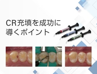 CR充填を成功に導くポイント